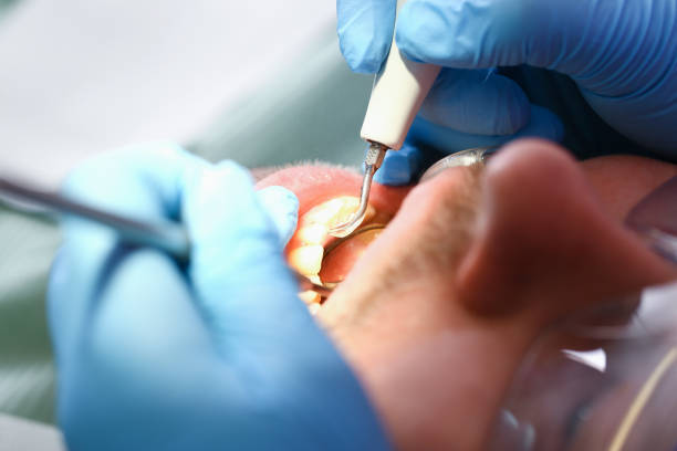 Best Emergency Dentist for Lost Fillings or Crowns in West Freehold, NJ